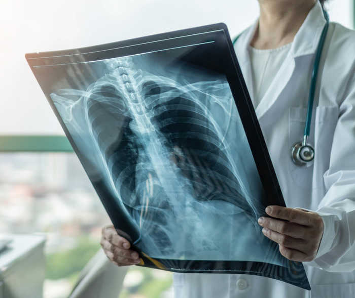 Leben mit NET: Eine Ärztin hält das Röntgenbild einer Lunge in den Händen Leben mit NET: Eine Ärztin hält das Röntgenbild einer Lunge in den Händen