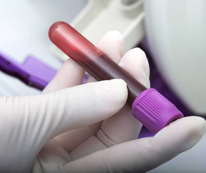 Leben mit NET: Ein Röhrchen mit einer Blutprobe in der Hand einer Laborassistentin Leben mit NET: Ein Röhrchen mit einer Blutprobe in der Hand einer Laborassistentin